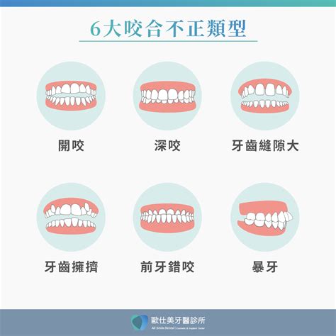 上下排牙齒平行|你的上下排牙齒 總是無意識咬合？